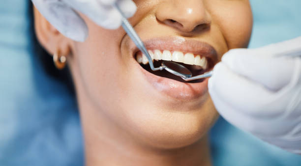 Best Emergency Wisdom Teeth Removal in White City, FL